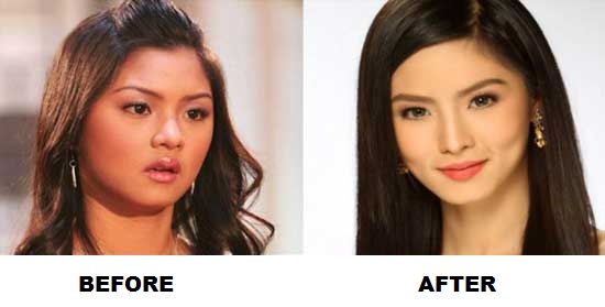Filipina filipino appearance beauty nose job plastic surgery skin whitening